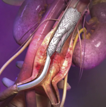 ENDOPROTHÈSE AORTIQUE ABDOMINALE