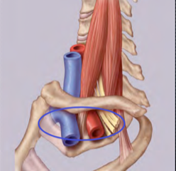 Syndrome du défilé cervico-thoraco-brachial