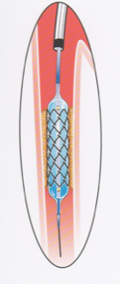 Dilatation fémorale